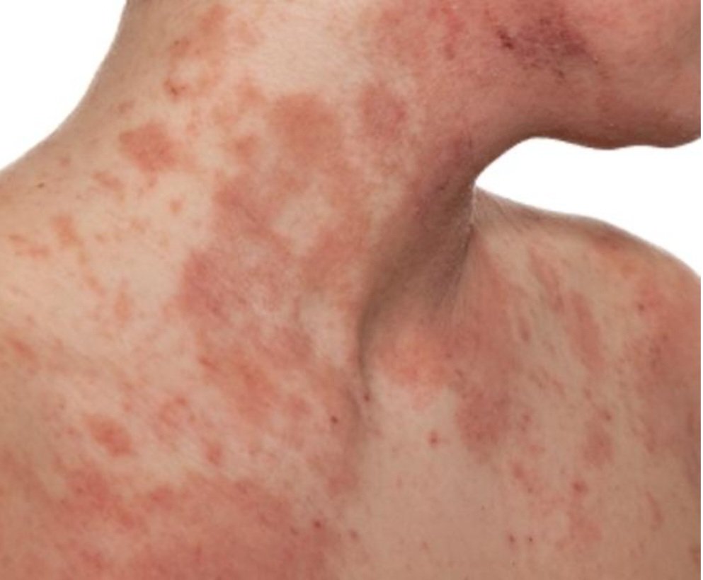Lupus