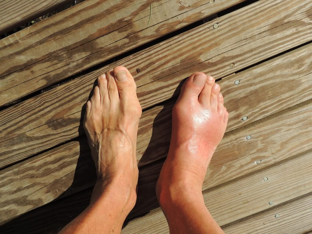 Gout