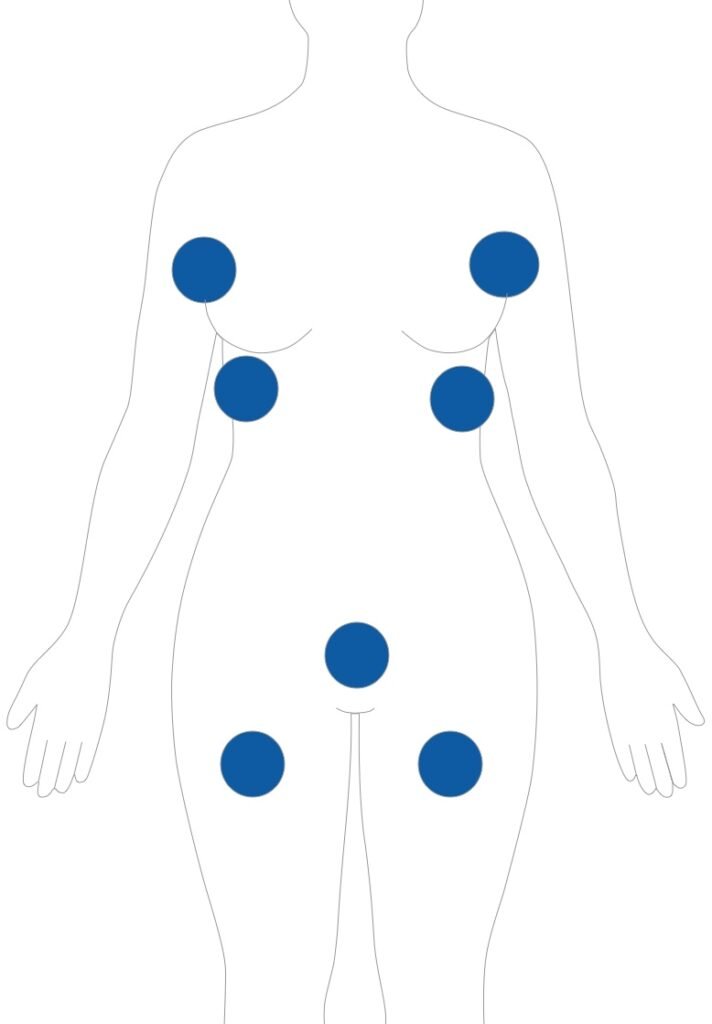 Hidradenitis Suppurativa